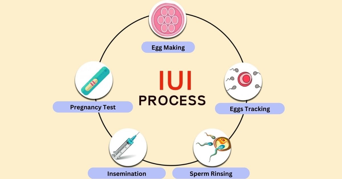 IUI-Treatment